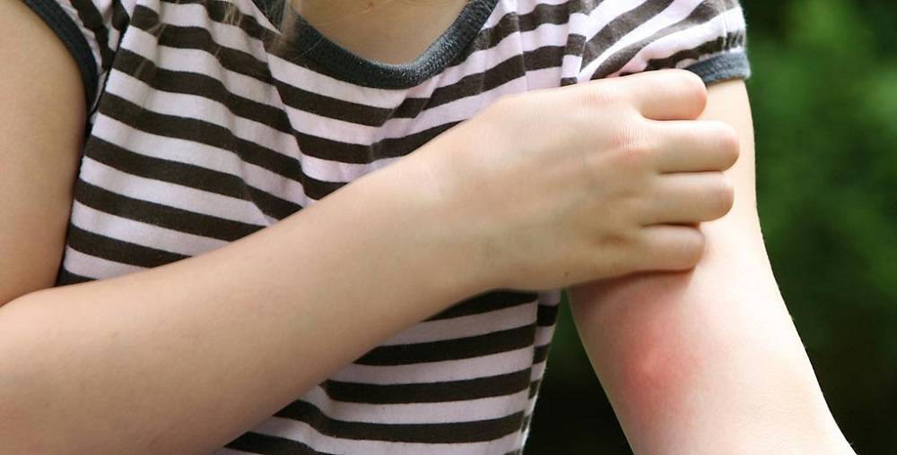 Как проявляется аллергия на мошек и комаров, как предотвратить и чем лечить