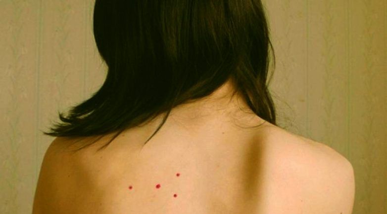 Родинки в виде треугольника на теле