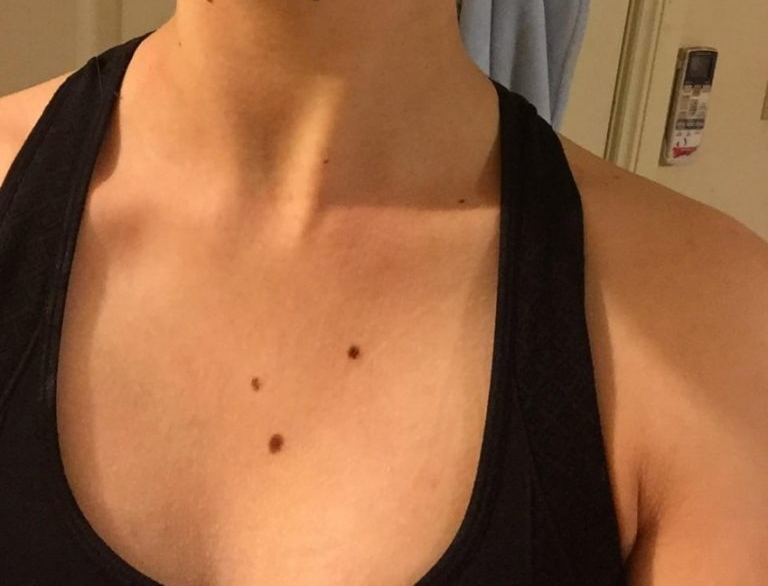 Родинки в виде треугольника на теле